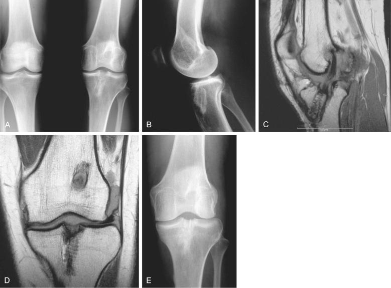 FIG 8-3, A, A 31-year-old woman with failure of a primary anterior cruciate ligament (ACL) semitendinosus-gracilis autograft and revision anterior tibial allograft of the left knee. B, A bone graft of a large tibial tunnel was performed with allograft. C and D, The allograft procedure did not provide a restitution of the tibial tunnel and a residual widening was present. E, A repeat bone graft using autogenous iliac crest was required to obtain bone of sufficient quality for an ACL revision.