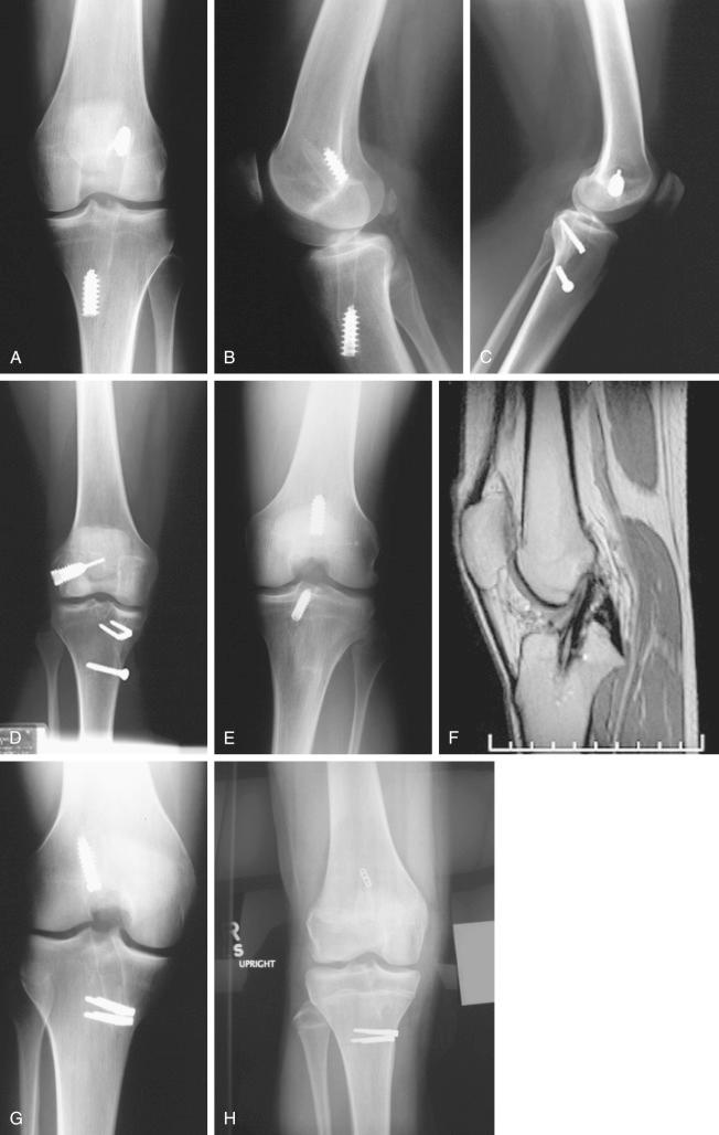 FIG 8-4, Patients who presented to our center for anterior cruciate ligament (ACL) revision with a vertical ACL graft, easily detected on anteroposterior and lateral radiographs and magnetic resonance imaging. The femoral graft location is primarily on the notch roof. In our experience, this vertical graft orientation is the primary cause for ACL failure.