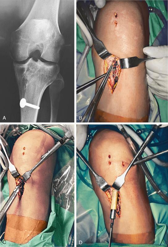 FIG 8-5, A 21-year-old soccer player with a failed anterior cruciate ligament (ACL) semitendinosus-gracilis allograft reconstruction and marked dilation and widening of the tibial and femoral tunnels (A) required a staged bone graft. B, Debridement of the tibial tunnel. C, Drilling of the tibial tunnel over a guide pin placed in the prior tunnel. Instead of an acorn drill, a regular drill was used with complete cutting threads throughout the shaft to provide a constant-diameter tunnel for the core bone graft to be inserted and fit snugly into the tunnel. The femoral tunnel was also debrided and a guide pin placed through the tibial tunnel for a similar drilling procedure. The majority of these cases involve transtibial drilling techniques. If an accessory anteromedial portal is used for the femoral tunnel, then a similar technique is used to bone graft the femoral tunnel. D, Insertion of a 12-mm freeze-dried core allograft under arthroscopic control, performed after the femoral tunnel has been grafted.