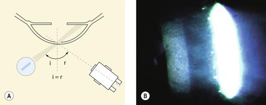Fig. 1.12, (A) Specular reflection illumination technique. i = angle of incidence; r = angle of reflection. (B) Specular reflection view of the corneal endothelium.