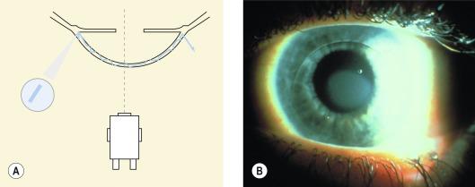 Fig. 1.13, (A) Sclerotic scatter illumination technique. (B) Central corneal oedema viewed using sclerotic scatter.