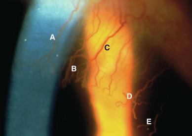 Fig. 1.6, Slit lamp photograph of contact lens–induced neovascularization, whereby the vessels can be viewed using (A) direct focal illumination, (B) indirect focal illumination, (C) direct retroillumination, (D) marginal retroillumination and (E) indirect retroillumination.