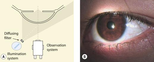 Fig. 1.7, (A) Diffuse illumination slit lamp technique. (B) Diffuse illumination view of the cornea.