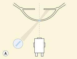 Fig. 1.8, (A) Direct parallelepiped illumination technique. (B) Direct parallelepiped view of the cornea.