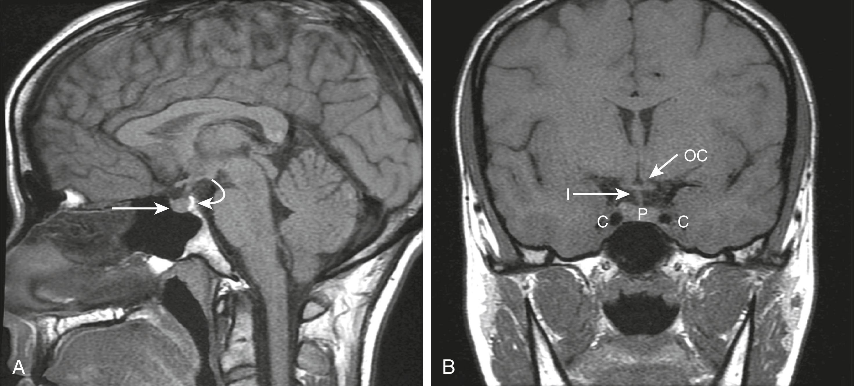 FIGURE 205-2, Magnetic resonance image of normal pituitary.