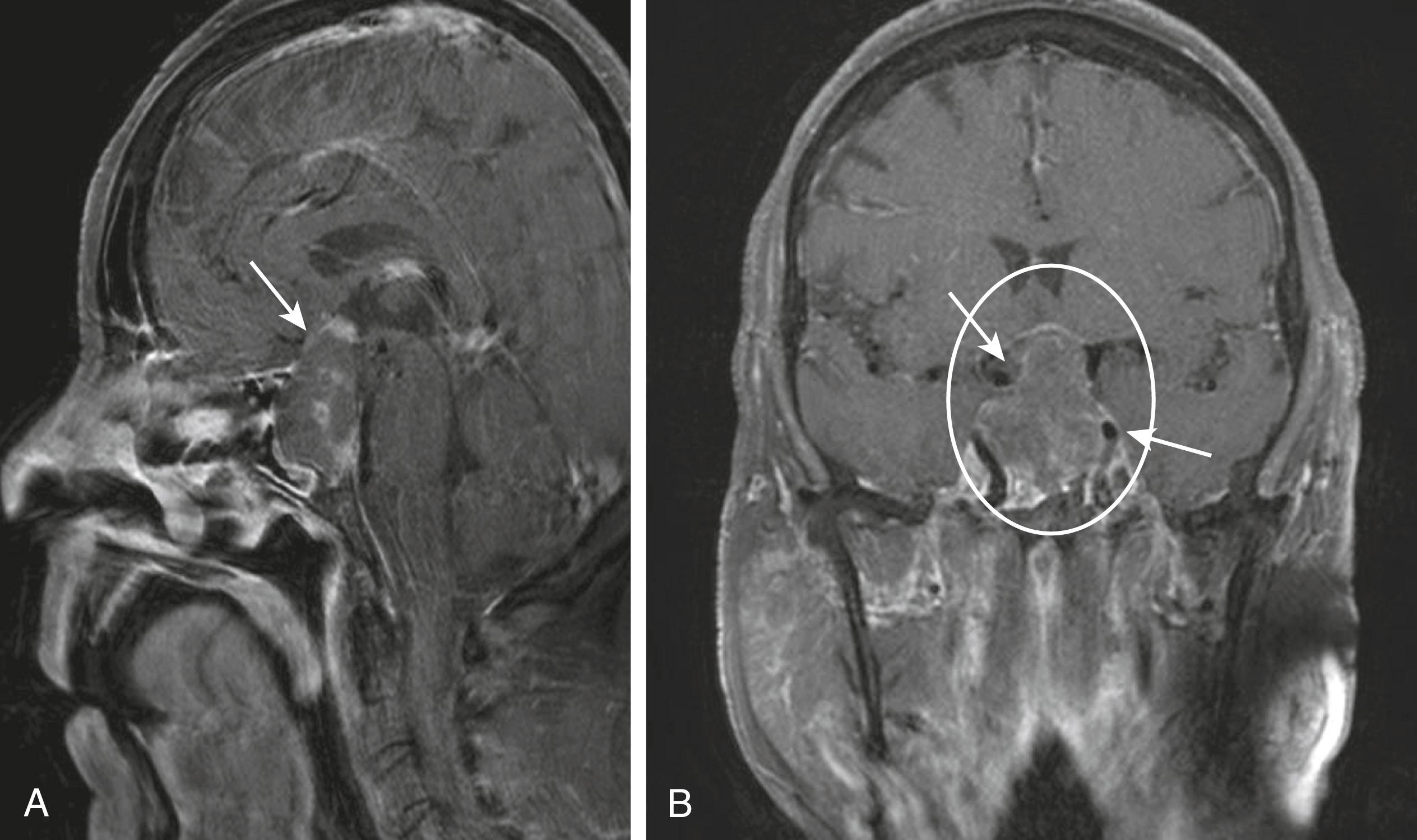 FIGURE 205-3, Magnetic resonance image of a large pituitary macroadenoma.