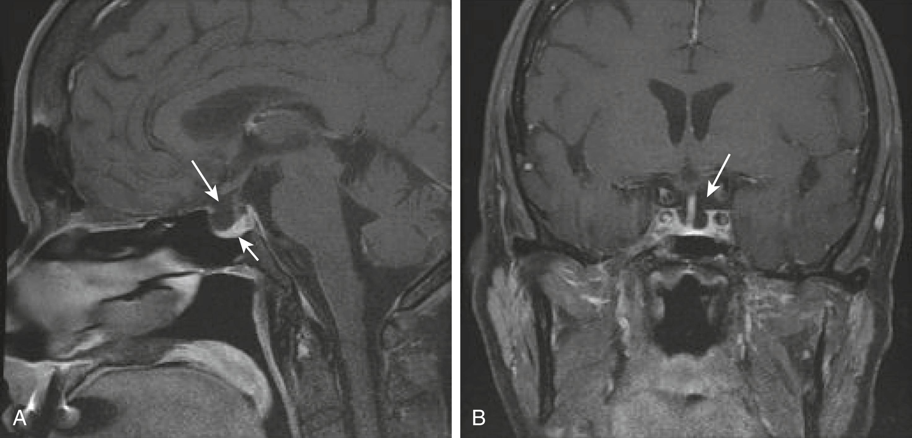 FIGURE 205-4, Magnetic resonance image of an empty sella.