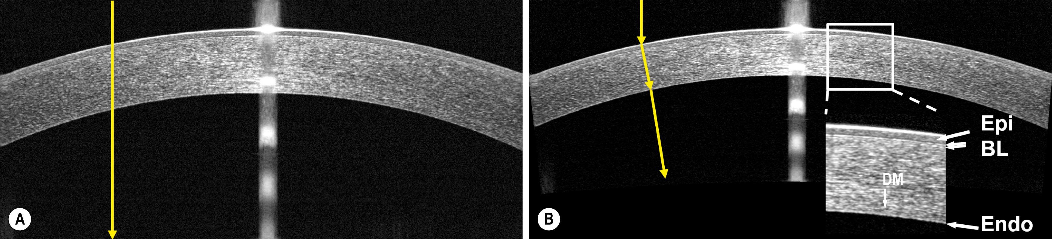 Fig. 17.1, A raw ( A ) and dewarped ( B ) 840-nm Fourier-domain optical coherence tomography image of a human cornea. Eight repeated frames were averaged to reduce speckle noise. Yellow arrow-headed lines marked a column of pixels in the raw (distorted) image and the corresponding pixels in the dewarped (real corneal anatomy) image. Enlarged section of the cornea showed epithelium (Epi) , Bowman layer (BL) , and endothelium (Endo) .