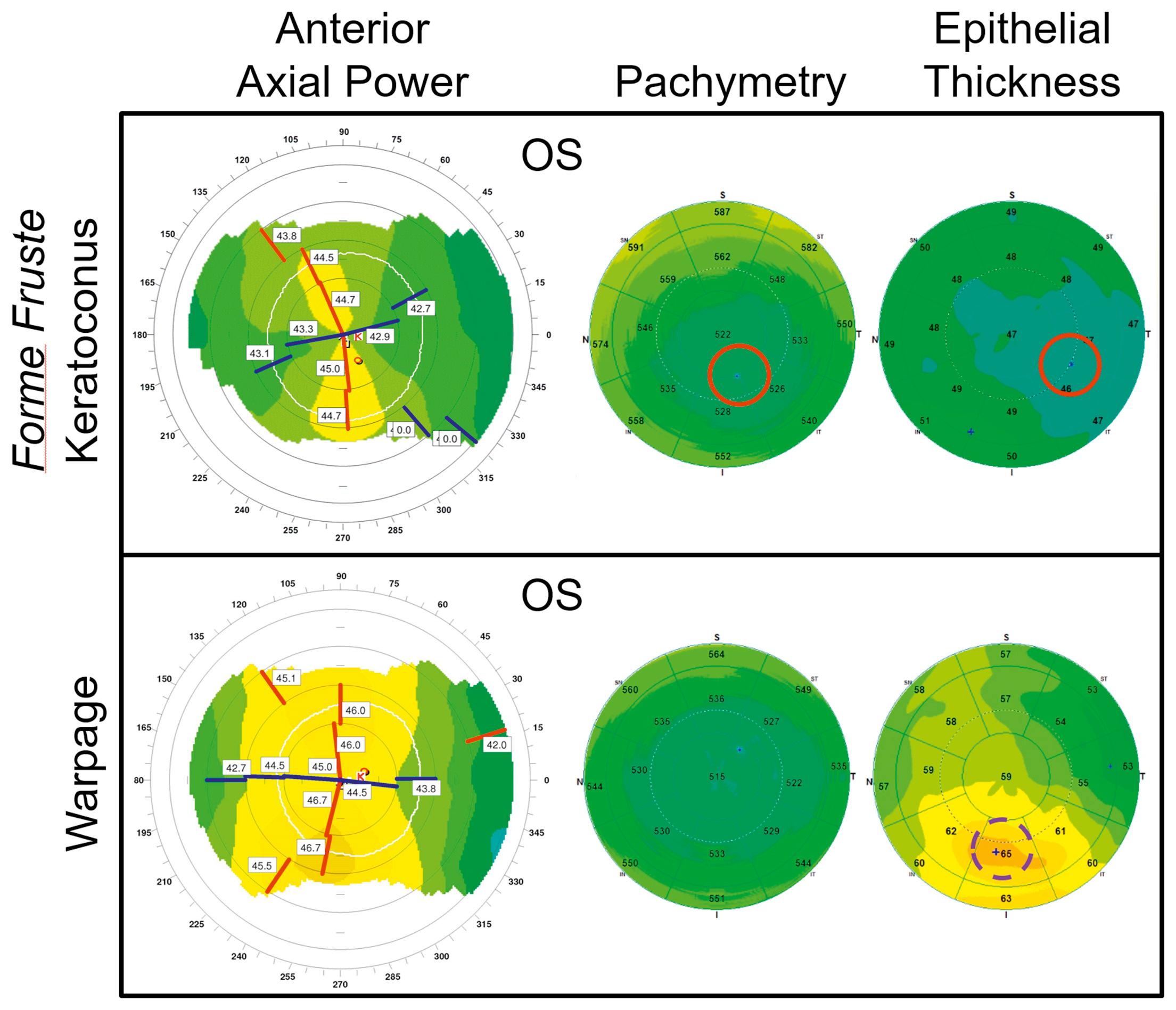 Fig. 17.2, A forme fruste keratoconus (FFK) and a contact lens–related warpage cases showing inferior focal steeping on anterior axial topography maps. These cases could be distinguished by optical coherence tomography thickness maps, which show coincident focal corneal and epithelial thinning (red circles) in FFK, in contrast to inferior focal epithelial thickening (dotted purple circle) in warpage.