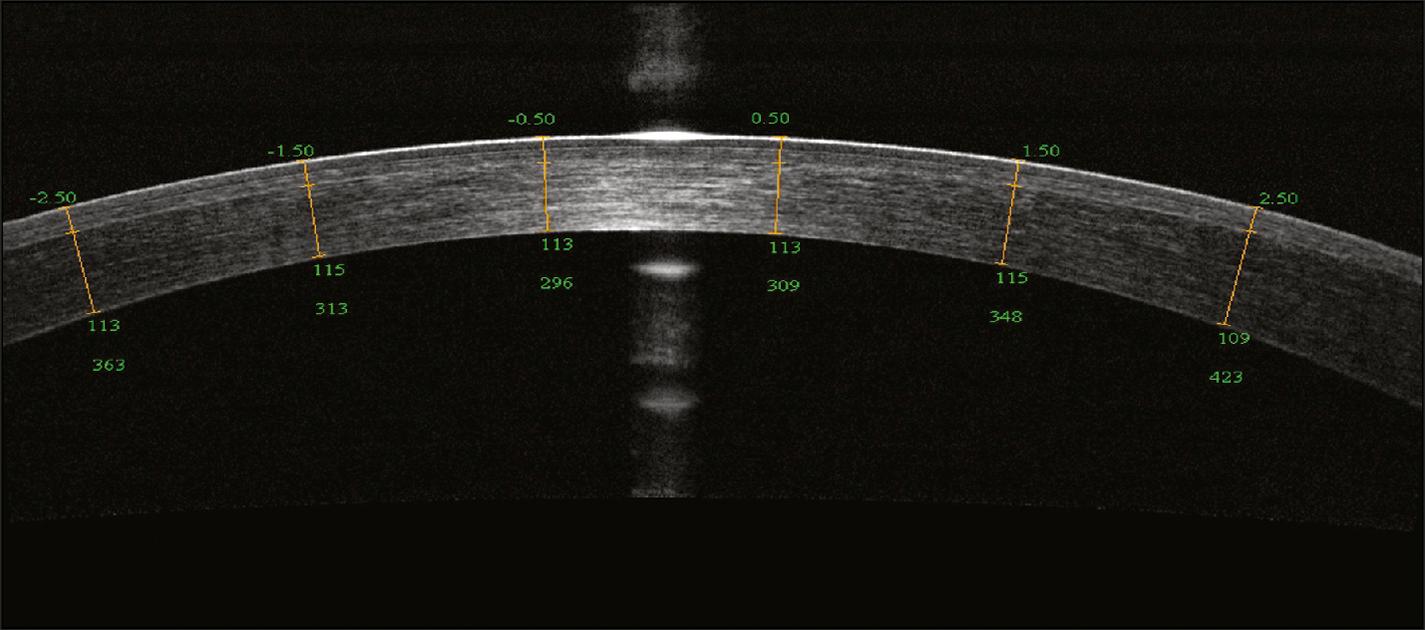 Fig. 17.3, 840-nm Fourier-domain optical coherence tomography image of a cornea 1 week after laser in situ keratomileusis with flap creation by a femtosecond laser. Sixteen repeated frames were averaged to enhance the image quality. Computer calipers measured the flap thickness to be 109−115 μm.