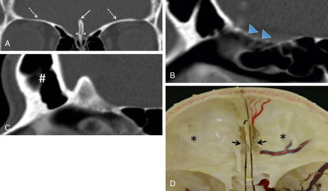 Fig. 1.1, Anterior skull base anatomy. Coronal CT images of the anterior skull base show the thin cribriform plate centrally consisting of olfactory grooves ( asterisks in A ) separated by the crista galli in the midline ( solid arrow in A ). There are tiny perforations on the floor of each olfactory groove as seen on sagittal CT ( arrowheads in B ). The thick orbital plates of the frontal bone form lateral portions of anterior skull base ( dashed arrows in A ). The anterior margin of the anterior skull base is formed by the frontal sinuses centrally ( hash in C ). Photograph of a dry skull specimen (D) shows the anterior skull base seen from above, demonstrating the central cribriform plate with multiple perforations ( arrows ) and the orbital plates laterally ( asterisks ).