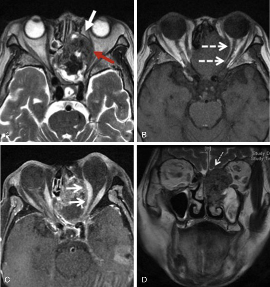 Fig. 1.2, Squamous cell carcinoma. Axial T2 and T1 (A and B) , coronal T2 (C) , and axial fat-suppressed T1 postcontrast (D) images show a necrotic sinonasal tumor invading through the cribriform plate and the medial orbital wall. Note the black line representing bowed intact periorbita anteriorly ( white arrow in A ), but the posterior aspect of the periorbita is indistinct ( red arrow in A ), consistent with orbital invasion. Mass effect on the optic nerve ( dashed arrows in B ) and medial rectus muscle ( solid arrows in C ) is clearly depicted. Dural invasion in the anterior cranial fossa is also present ( dashed arrow in D ) without brain involvement.