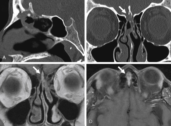 Fig. 1.3, Anterior skull base erosion. Sagittal and coronal CT images (A and B) show a small lesion that is centered in the roof of the anterior ethmoid sinus and erodes into the frontal sinus and crista galli ( asterisk in A ). CT is superior in depicting osseous erosion into the right olfactory groove ( white arrow in B ). MRI is excellent in depicting intense postcontrast enhancement of the lesion ( arrows in C and D ). Note the absence of dural or brain involvement on MRI. This lesion is a histologically proven phosphaturic mesenchymal tumor, a rare tumor that has a tendency to cause oncogenic osteomalacia.