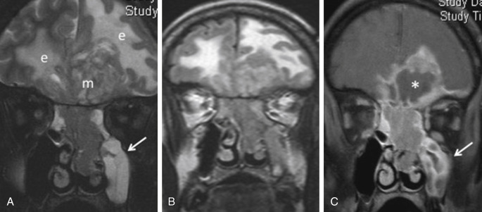 Fig. 1.5, Squamous cell carcinoma. Coronal T2 and fluid-attenuated inversion recovery (A and B) and coronal fat-suppressed T1 postcontrast (C) images show an aggressive tumor (m) eroding through the cribriform plate and invading the frontal lobes, which show parenchymal edema (e). Note the necrotic appearance of the intraparenchymal component, best seen in postcontrast images ( asterisk in C ). Mucosal engorgement of the left maxillary sinus as a result of outlet obstruction is easily distinguished from tumor in the nasal cavity ( arrows in A and C ).