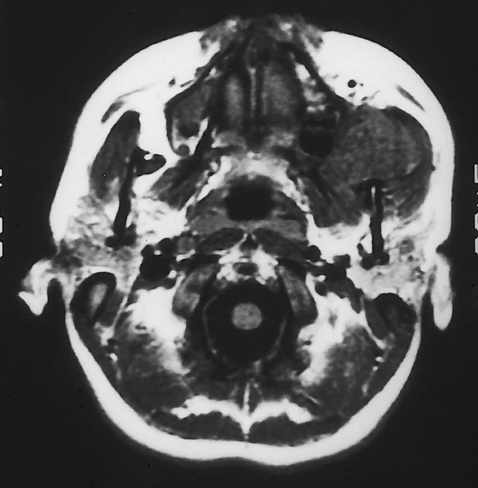 Fig. 49.1, A magnetic resonance image shows a soft tissue tumor involving the infratemporal fossa. Even malignant tumors of the infratemporal fossa may reach a large size before they are visible or palpable on physical examination. Patients with such tumors may present with facial numbness, pain, or difficulty with mastication.