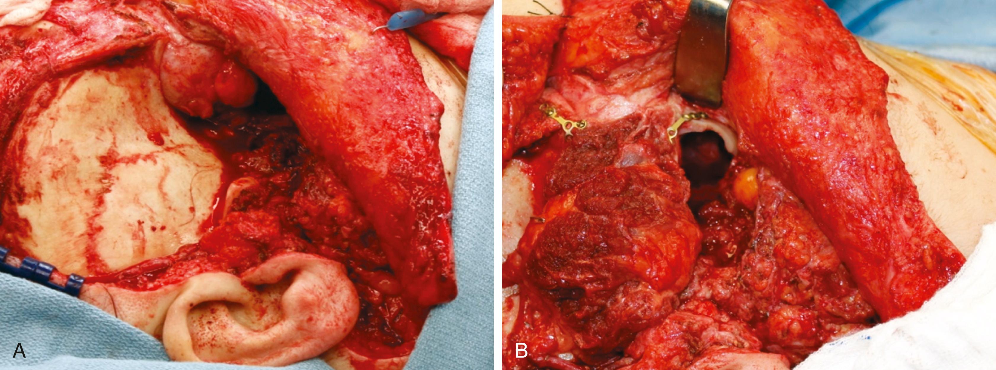 Fig. 49.2, (A) A defect of the right infratemporal fossa involving the temporalis muscle, zygoma, and lateral orbital wall. (B) Reconstruction was performed using a scapular tip–thoracodorsal arterial perforator (TDAP) flap (the bone of the scapular tip was used to recreate the lateral orbital wall and zygoma, and the TDAP was de-epithelialized and used to recontour the temporal fossa. A portion of the teres major surrounding the scapular tip was reflected to obliterate the infratemporal fossa [ITF]).