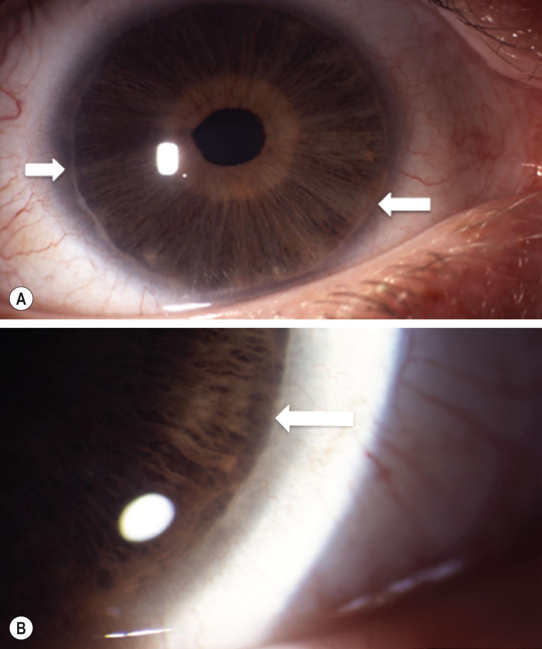 Fig. 31.1, Posterior embryotoxon. (A) Marked posterior embryotoxon with iris strands attached (Axenfeld–Rieger anomaly), white arrows. (B) Posterior embryotoxon with no associated ocular anomalies is a common but subtle anomaly seen on slit-lamp examination.