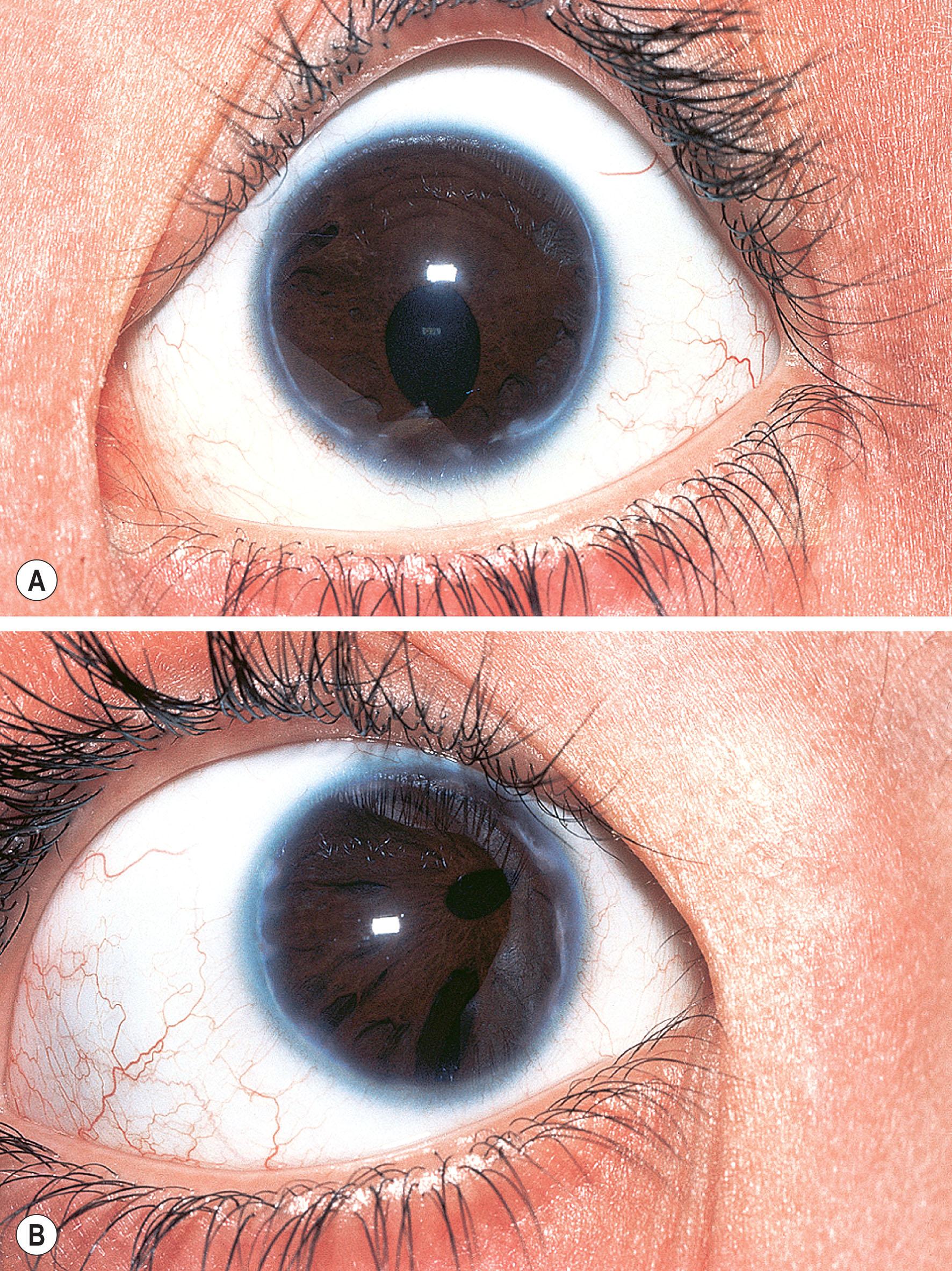 Fig. 31.2, Axenfeld–Rieger anomaly. There is iris hypoplasia, posterior embryotoxon, pseudopolycoria (A), and corectopia with the pupil drawn nasally (B).