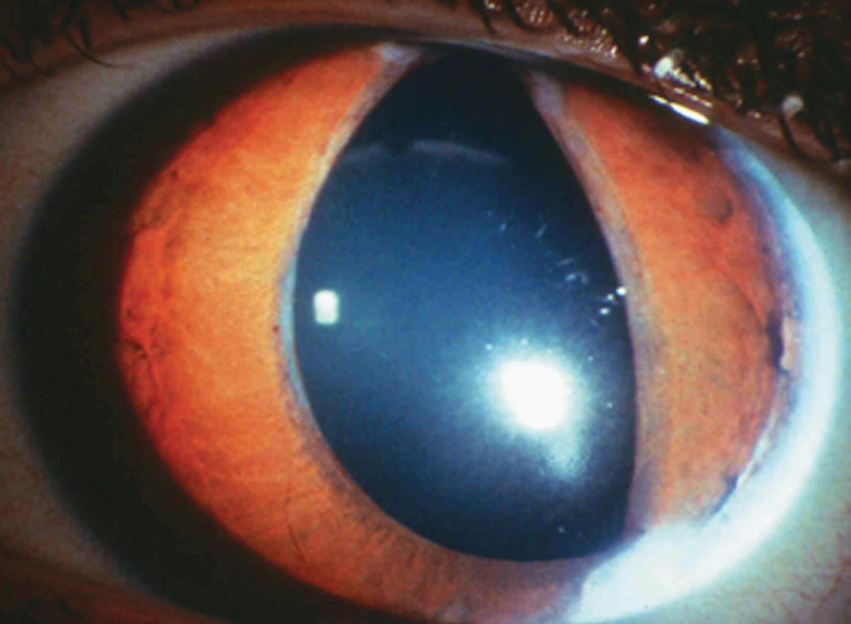 Fig. 31.3, Axenfeld–Rieger syndrome. Marked corectopia with pupil distortion and posterior embryotoxon.