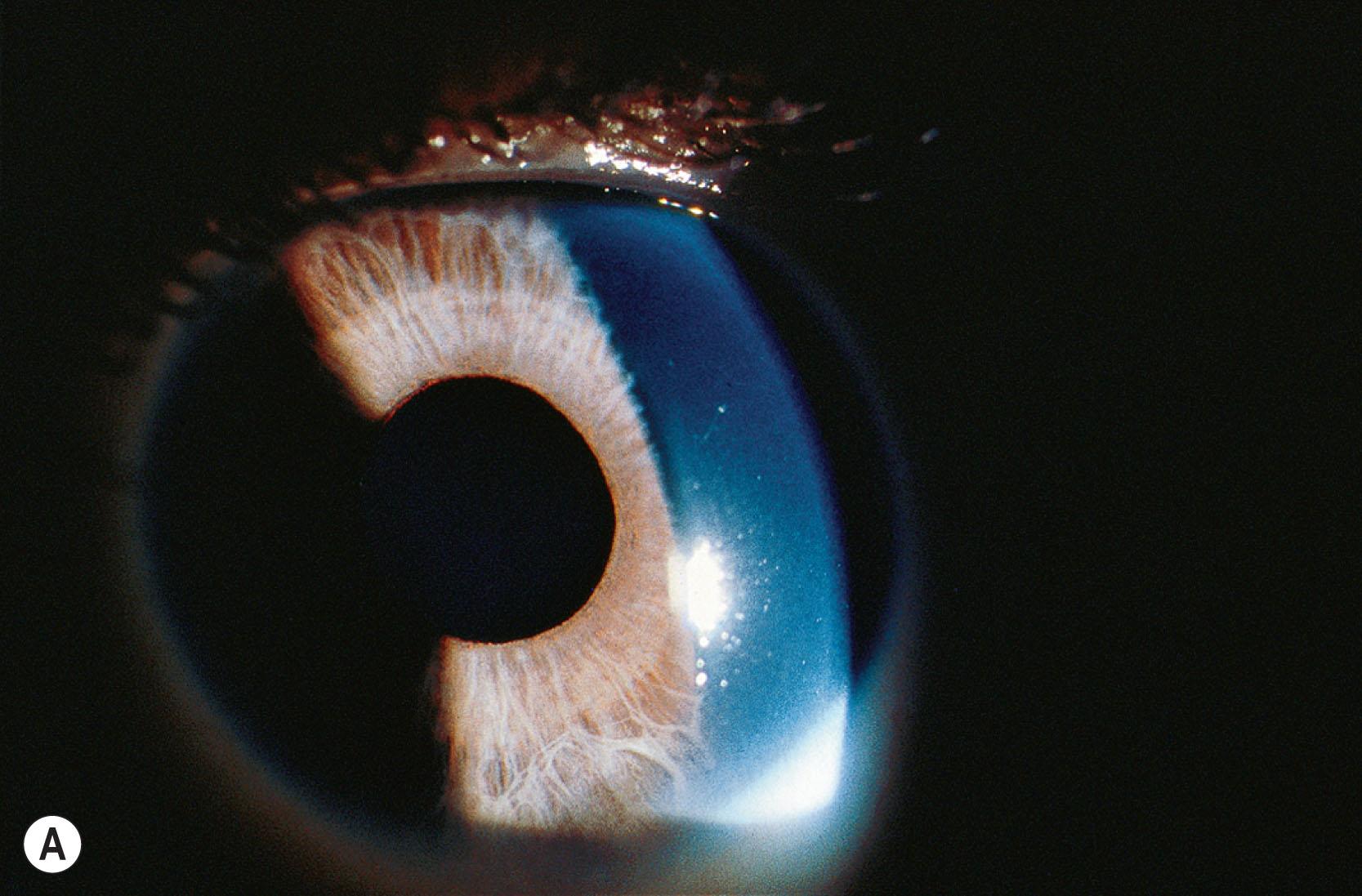 Fig. 31.4, Iris hypoplasia. (A) Iris hypoplasia showing the loss of stroma resulting in prominence of the sphincter muscle. (B) Marked stromal hypoplasia revealing the posterior pigmented epithelium. (C) Marked stromal hypoplasia giving rise to pseudopolycoria in Axenfeld–Rieger anomaly (ARA). (D) Pseudopolycoria in ARA seen in retroillumination.