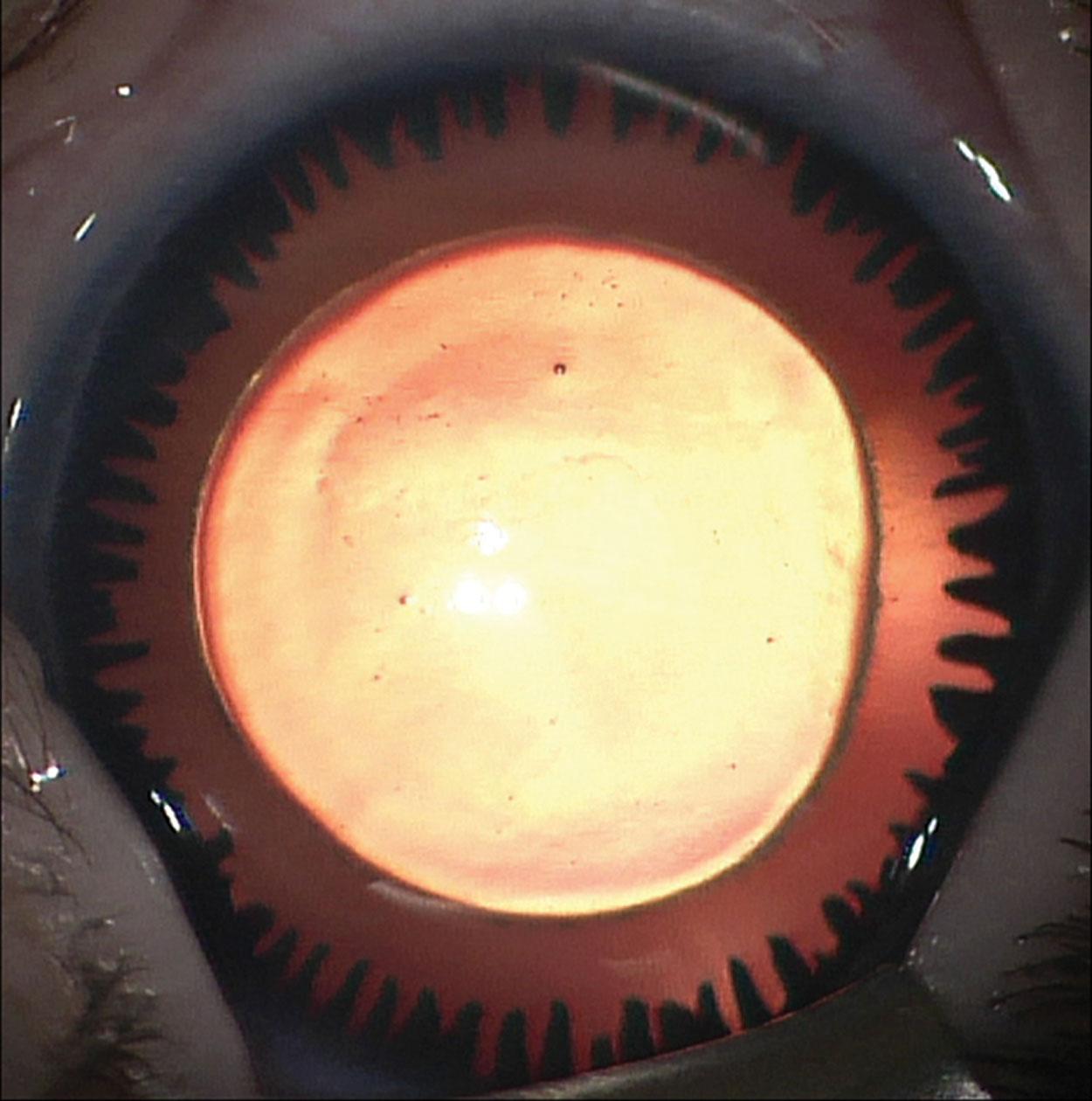 Fig. 31.5, This child has a deletion of 6p25 that includes FOXC1 . This has resulted in complete absence of the iris.