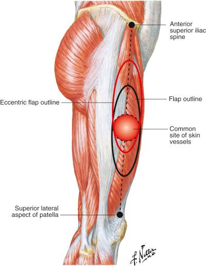 Figure 59.2, Anatomic landmarks and flap marking.