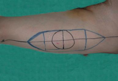 Figure 59.3, Marking of the anterolateral thigh flap.