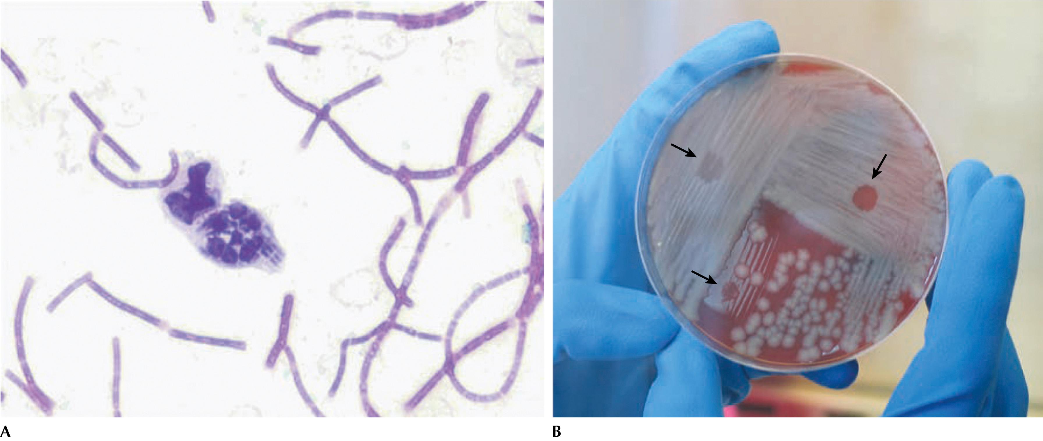 Fig. 90.1, In vitro and clinical images of Bacillus anthracis . (A) Gram stain of infected guinea pig blood smear demonstrating intracellular bacilli chains next to a polymorphonuclear leukocyte. (Courtesy of Susan Welkos, PhD, Division of Bacteriology, US Army Medical Research Institute of Infectious Diseases, Fort Detrick, Maryland.) (B) Isolated colonies of Bacillus anthracis on sheep blood agar plate. The plate has been treated with an organism-specific gamma-phage causing cell lysis (arrows) .