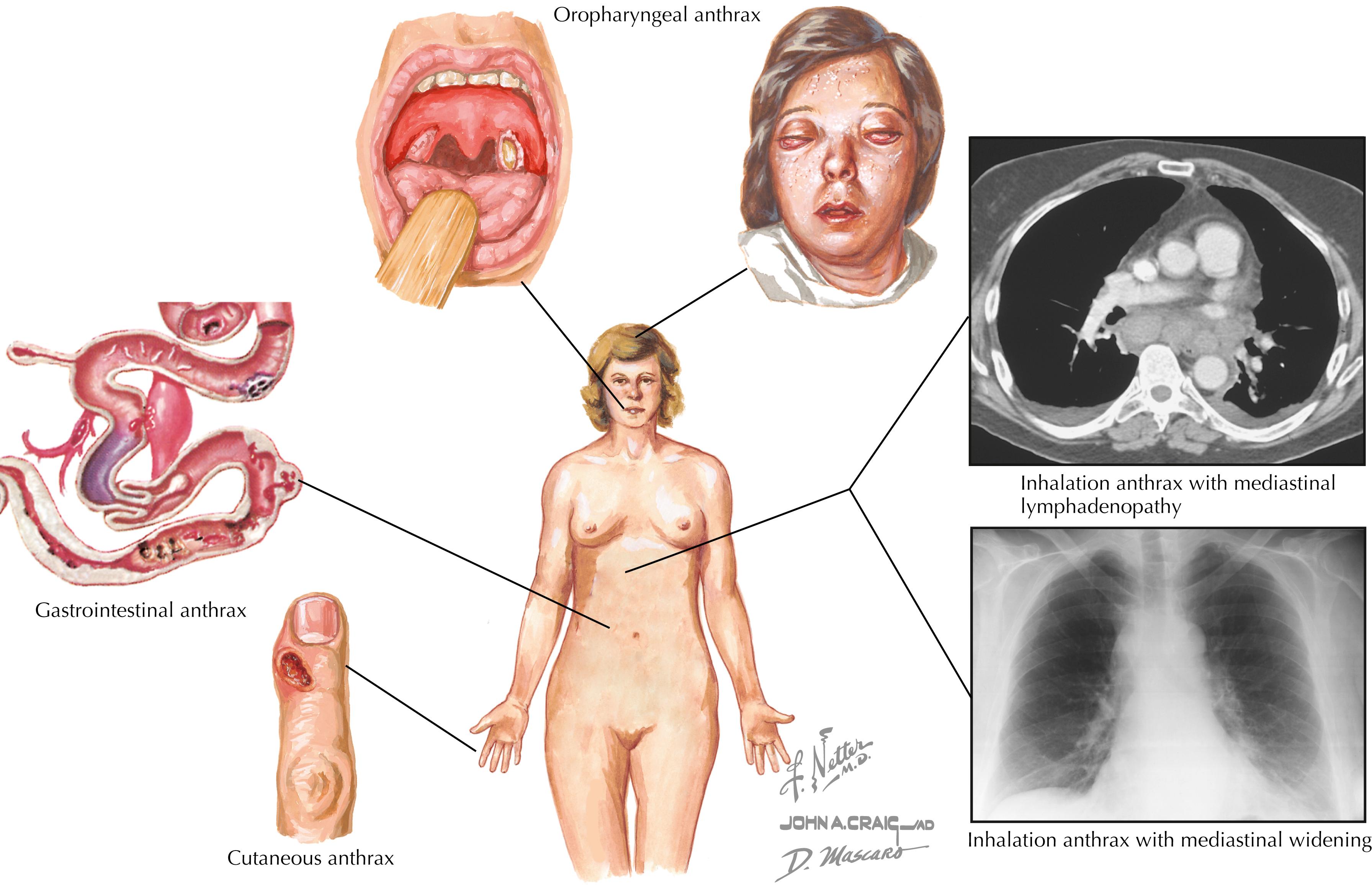Fig. 90.4, Bacillus anthracis causes three major clinical syndromes to include cutaneous, oropharyngeal-gastrointestinal, and inhalational forms. Cutaneous anthrax is most common with a self-limited edematous ulcer forming on the skin of areas in contact with infectious spores. Oral and GI anthrax result from consuming contaminated animal products, most commonly meat, and feature ulcerative disease of the oropharynx and GI tract. Inhalation anthrax is the most severe form, and most commonly associated with deliberate biological attack through inhaling anthrax spores. The inhalational form begins with protean systemic symptoms, which rapidly progress to mediastinitis with widening seen on imaging studies, septic shock, meningitis, and death if untreated.