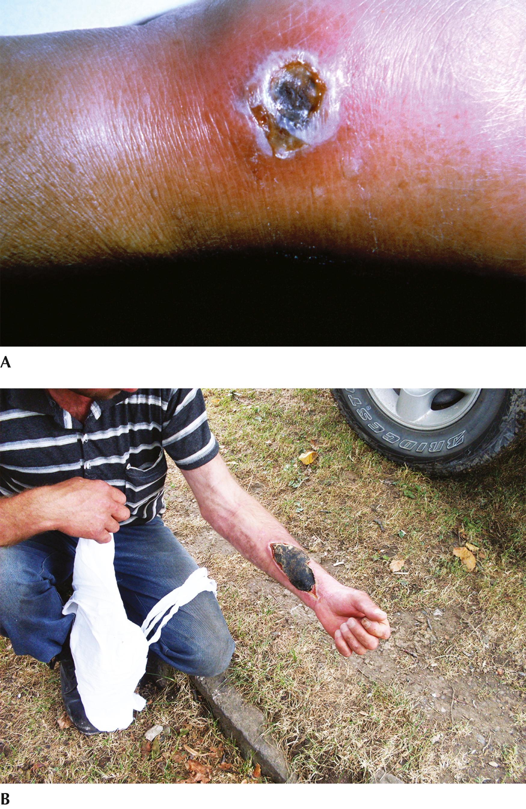 Fig. 90.5, Characteristic lesions of (A) cutaneous anthrax with black eschar over an ulcerated base; and (B) significant surrounding edema