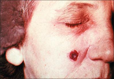 Figure 28-2, Anthrax ulcer on the face.