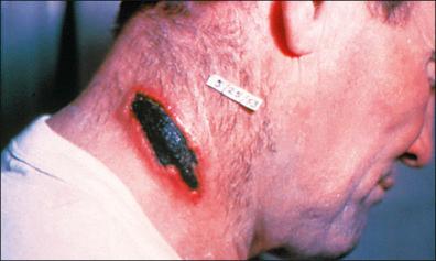 Figure 28-3, Anthrax eschar of the neck.