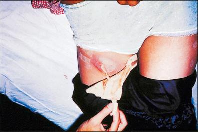 Figure 28-6, A bubo of the femoral lymph nodes in a patient with bubonic plague .