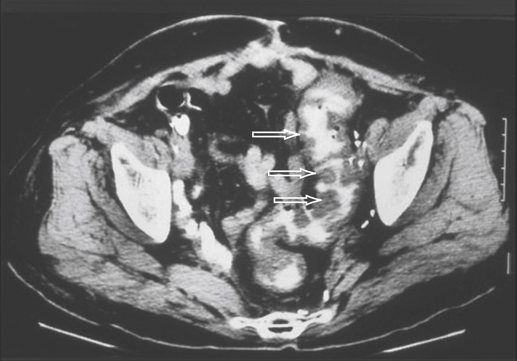 Fig. 112.5, CT of the abdomen in a patient with C. difficile colitis. Marked thickening of the colonic wall in the sigmoid colon and an accordion-like pattern, produced by a series of broad edematous colonic haustral folds, are evident ( arrows ).