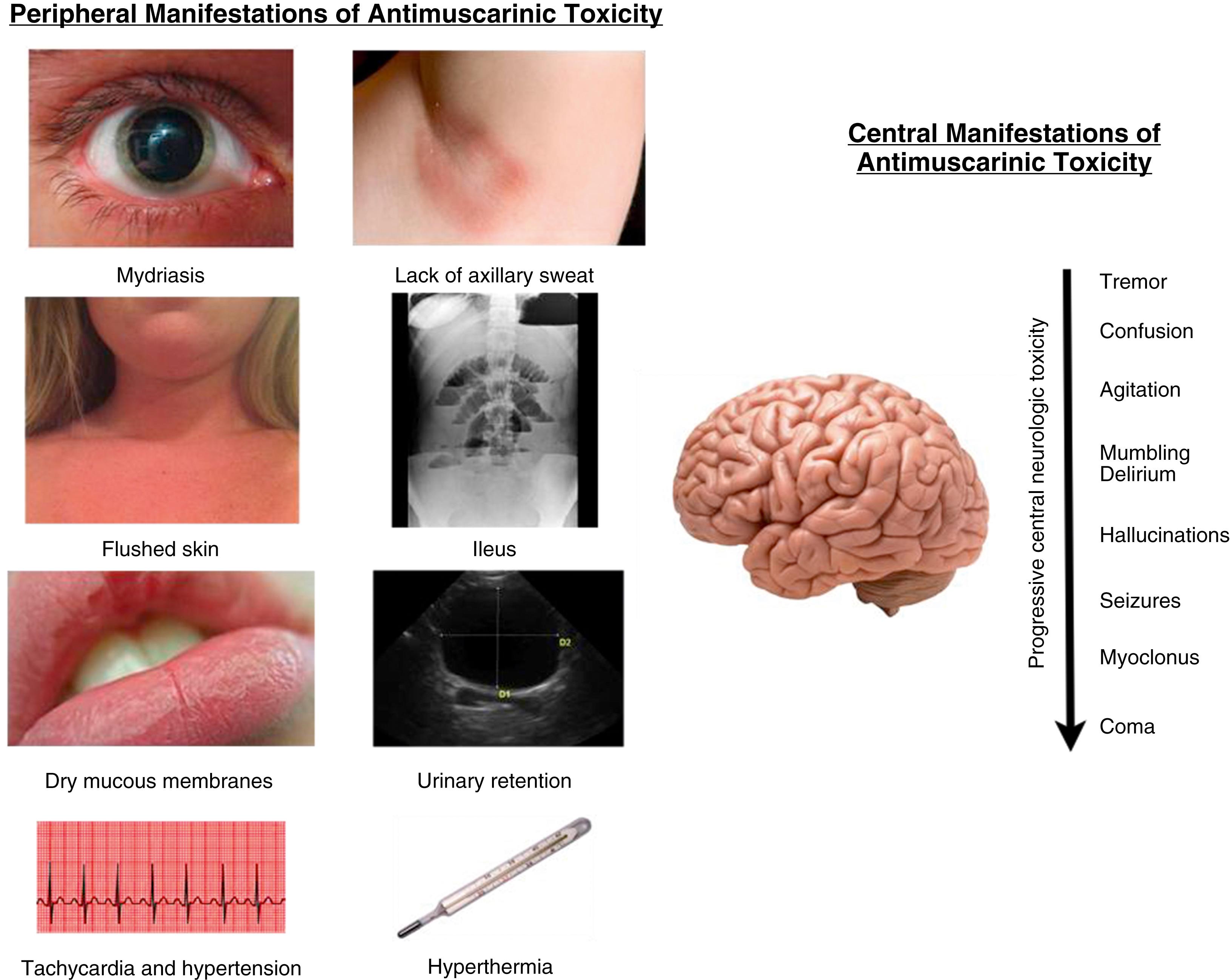 Fig. 140.1, Signs and symptoms of antimuscarinic toxicity.