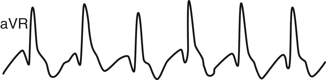 Fig. 141.1, Augmented vector right (aVR) demonstrating tall R wave.