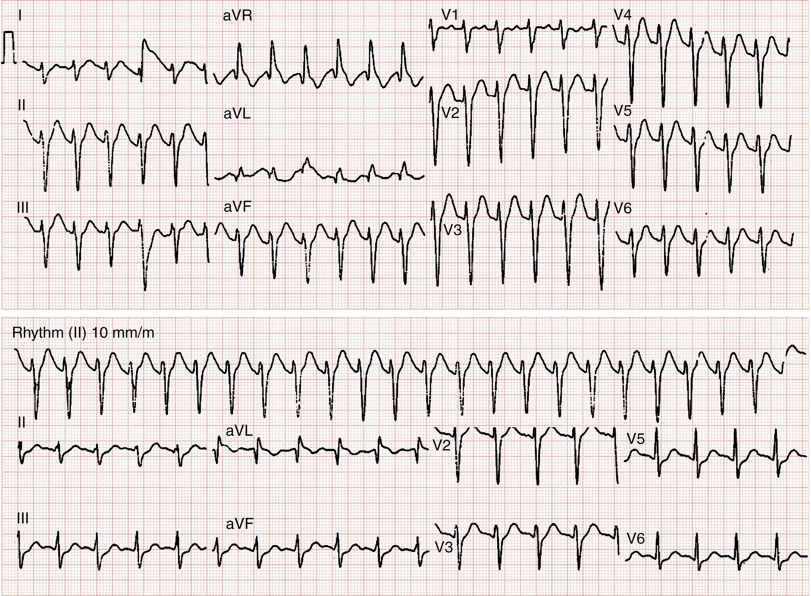 Fig. 141.2, Top, Initial 12-lead electrocardiogram (ECG) demonstrating substantial intraventricular conduction delay (QRS 141 milliseconds). Bottom, Repeated ECG after bicarbonate therapy.