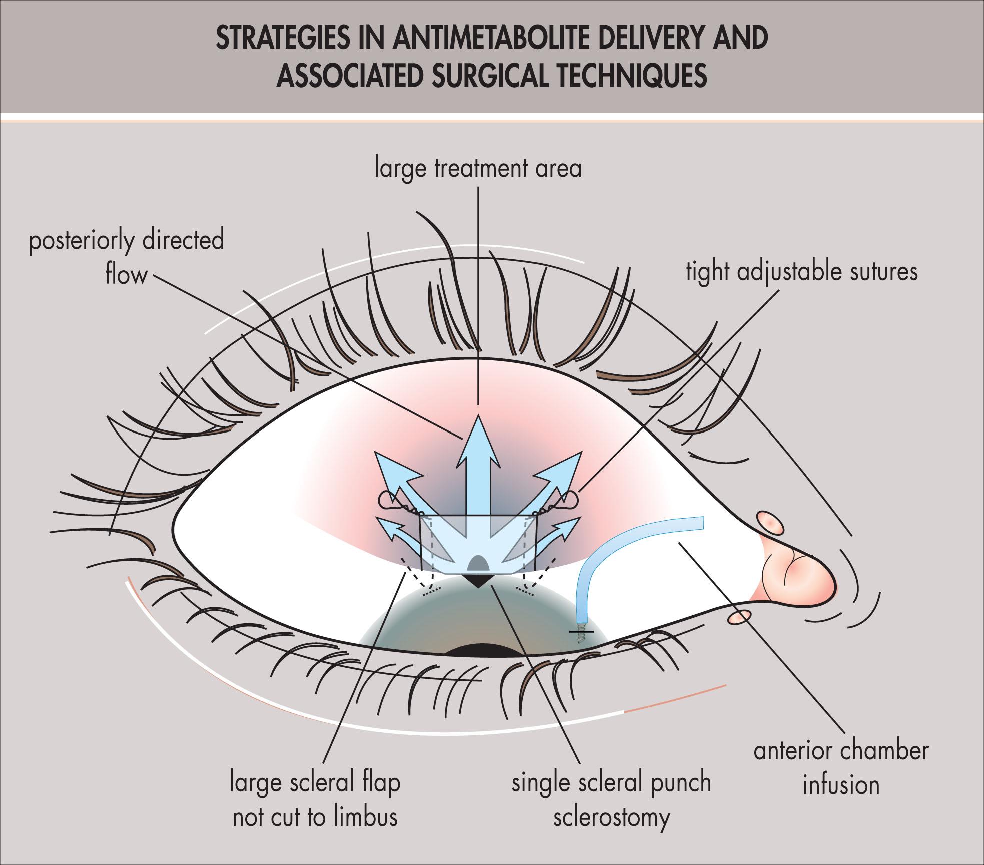 Fig. 10.28.1, Strategies in antimetabolite delivery and associated surgical techniques that increase safety and improve bleb appearance dramatically.