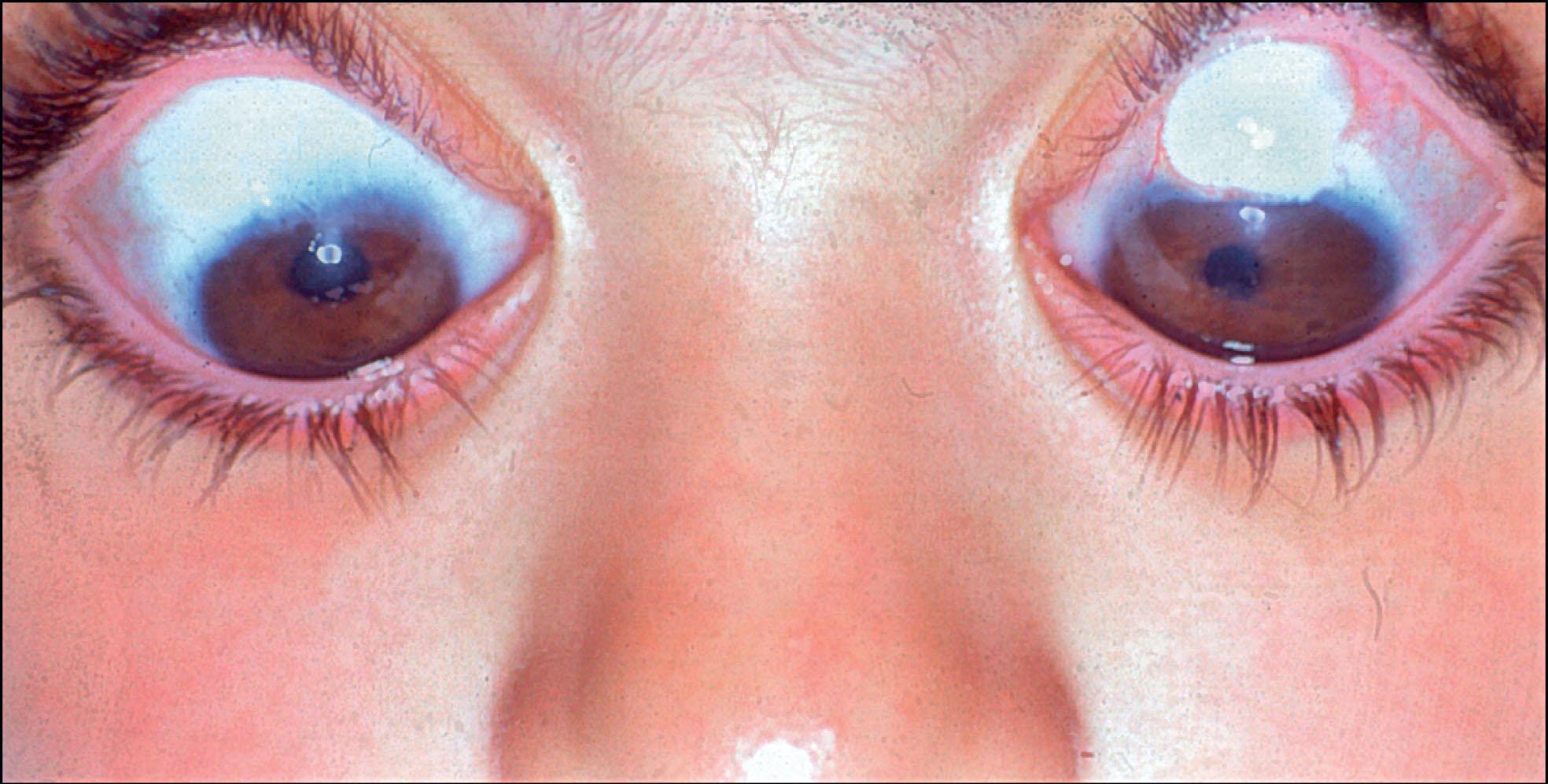 Fig. 10.28.2, Focal cystic bleb prone to leakage, infection, and dysesthesia in the left eye (limbus-based conjunctival flap, small scleral flap, and smaller area of mitomycin C [MMC] 0.4 mg/mL treatment). Diffuse noncystic bleb appearance in right eye of the same patient (fornix-based flap, larger scleral flap, and larger area of MMC 0.5 mg/mL treatment).