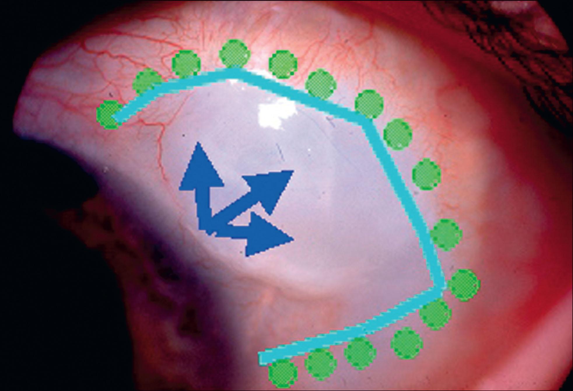 Fig. 10.28.3, Diagrammatic illustration of the “cystic bleb” hypothesis requirements for cystic bleb formation with or without antimetabolites. Blue arrows indicate anterior aqueous flow; light blue line and green dots indicate a ring of scar tissue, the so-called ring of steel.