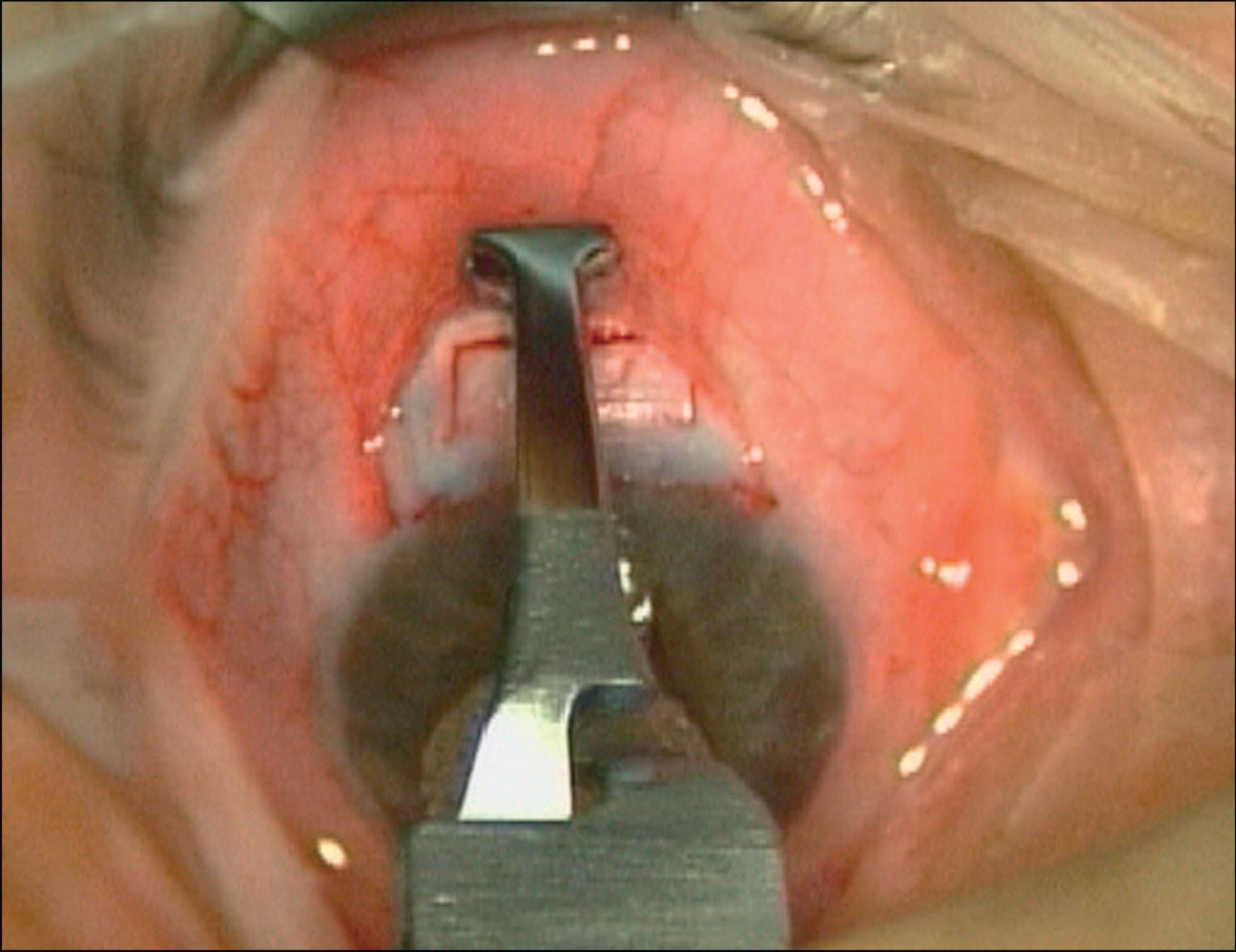 Fig. 10.28.4, Intraoperative Antimetabolite Being Applied.