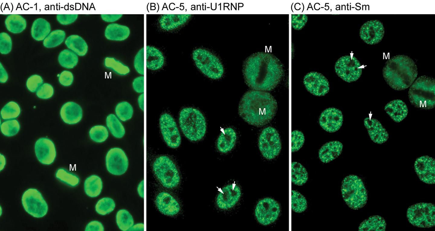 Figure 28.1, Indirect immunofluorescence of anti-histone and anti-snRNP antibodies on human HEp-2 cells.