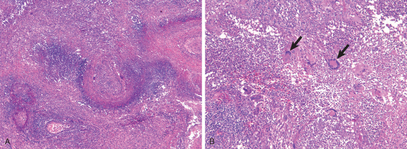 Fig. 46.1, Granulomatosis with polyangiitis: geographic necrosis. (A) Histologic specimen demonstrates areas of basophilic necrosis with irregular border, resulting in a geographic appearance. The necrotic regions are surrounded by a mixed inflammatory infiltrate. (B) High-power view demonstrates granulomatous inflammation and multinucleated giant cells (arrows) .