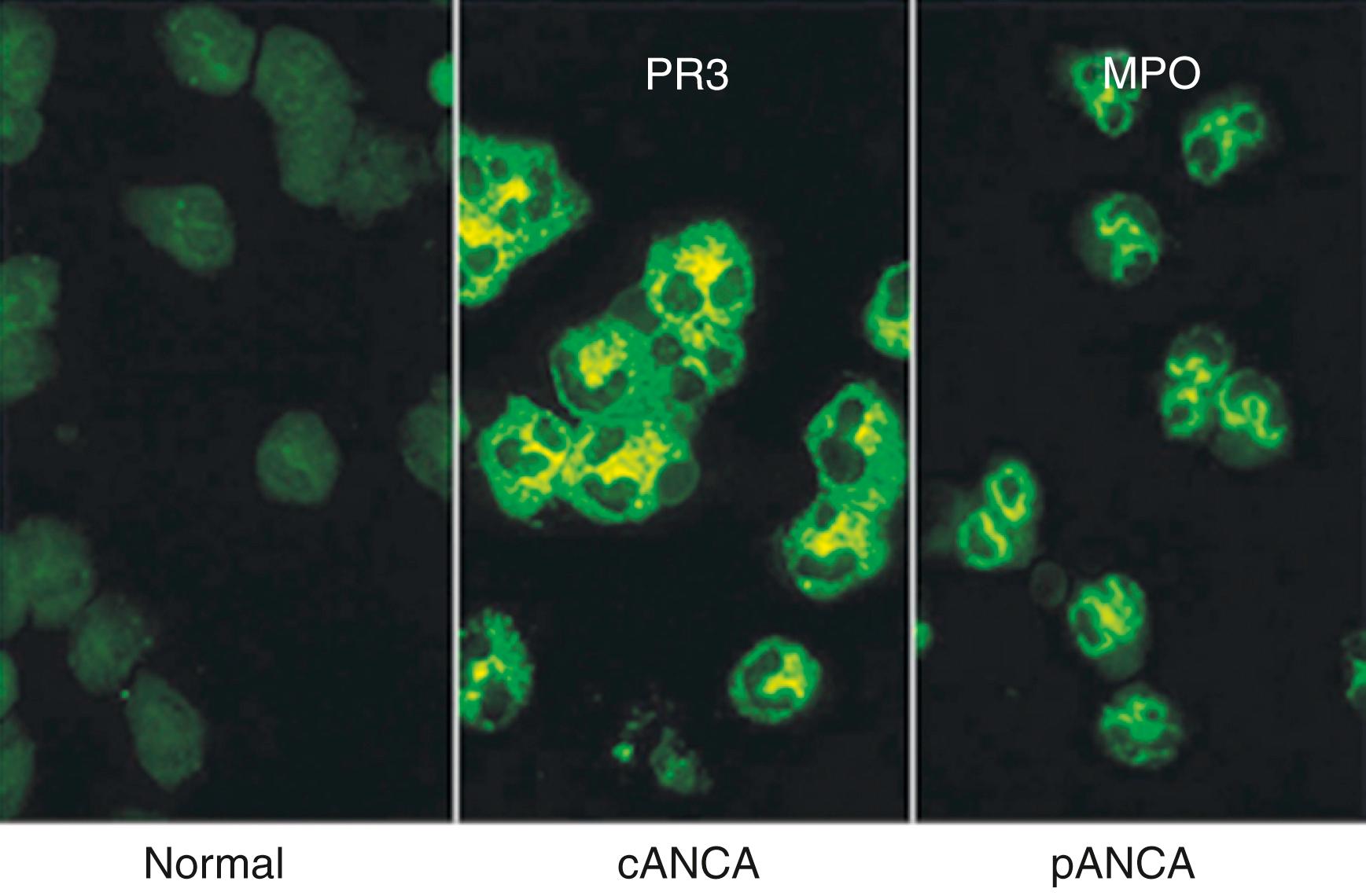 Fig. 36.1, On ethanol-fixed neutrophils, PR3-ANCA causes a characteristic cytoplasmic granular centrally accentuated immunofluorescence pattern, referred to as cANCA ( middle ), whereas MPO-ANCA causes a perinuclear immunofluorescence pattern, referred to as pANCA ( right ). 2