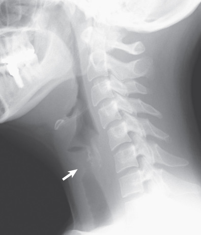 Fig. 46.11, Granulomatosis with polyangiitis: subglottic stenosis. Lateral view of the neck shows focal wall thickening of the subglottic trachea (arrow) with associated stenosis.