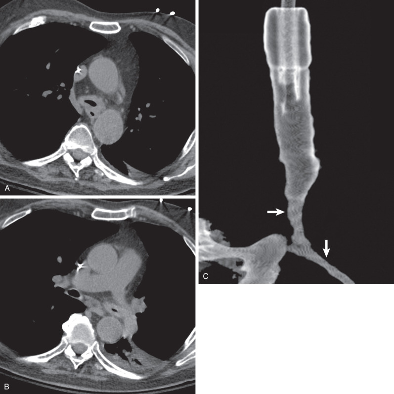 Fig. 46.12, Granulomatosis with polyangiitis: tracheal and bronchial stenosis. (A) Unenhanced CT image at the level of the azygos arch shows marked circumferential thickening of the wall of the trachea with associated luminal narrowing. (B) CT image at a lower level demonstrates circumferential thickening of the wall of the left main bronchus causing stenosis. Note associated partial left lower lobe atelectasis. (C) Three-dimensional reformatted image from a virtual bronchoscopy in a different patient shows stenosis (arrows) of the distal trachea and proximal main bronchi.