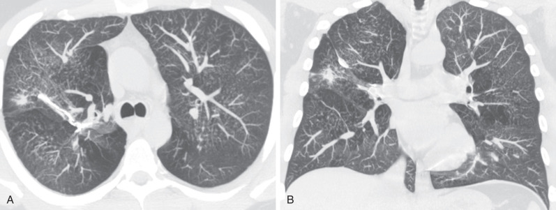 Fig. 46.13, Granulomatosis with polyangiitis (GPA): hemosiderosis. Axial (A) and coronal (B) maximum-intensity projection images show diffuse bilateral centrilobular nodules. A spiculated right upper lobe nodule is also noted relating to patient's known GPA. Surgical biopsy showed the centrilobular nodules represented hemosiderin secondary to repeated alveolar hemorrhage.