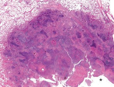 Fig. 46.2, Granulomatosis with polyangiitis: necrosis and cavitation. Histologic specimen shows nodule with necrosis and cavitation (asterisk).