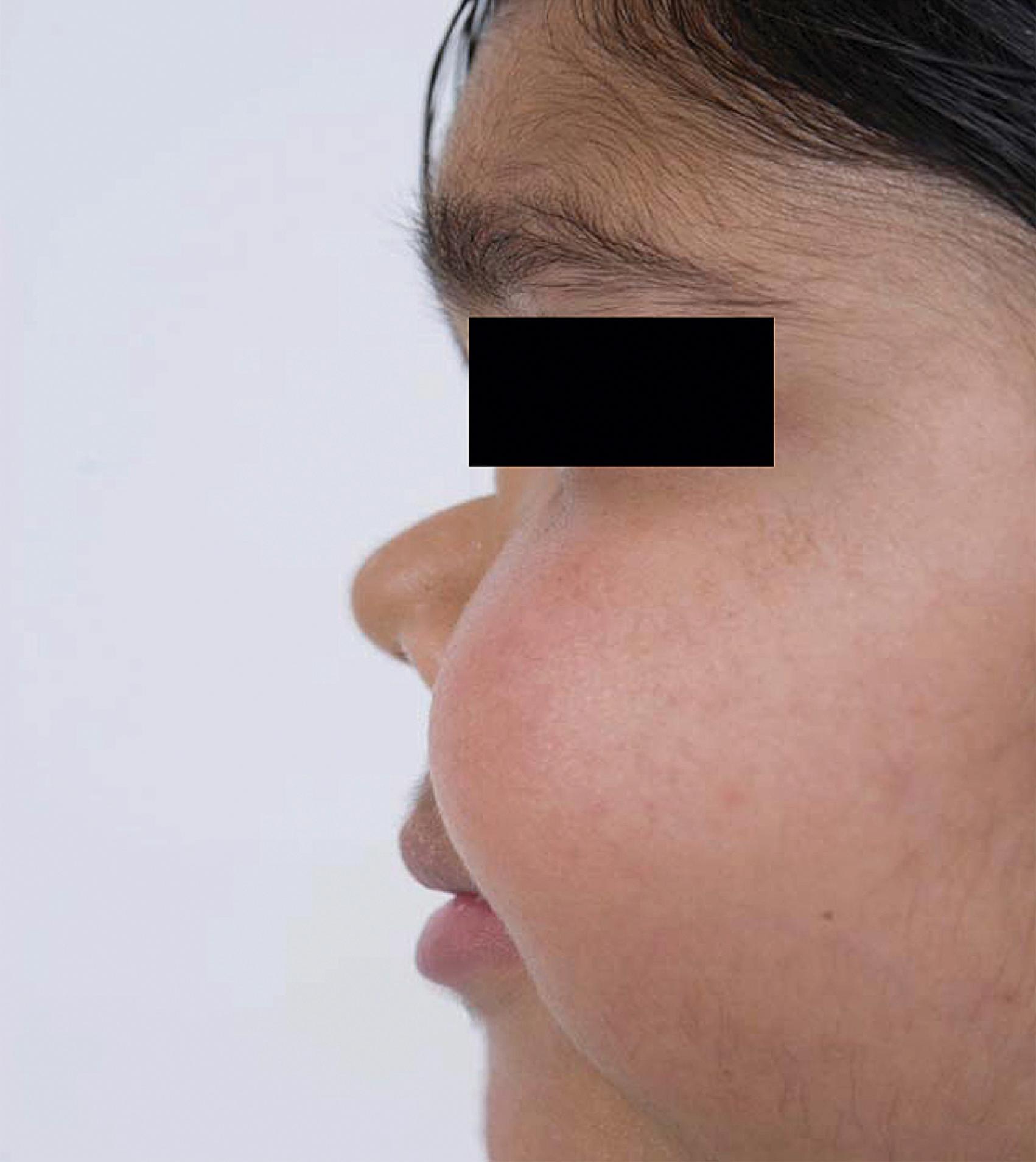 Fig. 36.2, Saddle-nose deformity in a girl with erosive sinusitis and granulomatosis with polyangiitis.