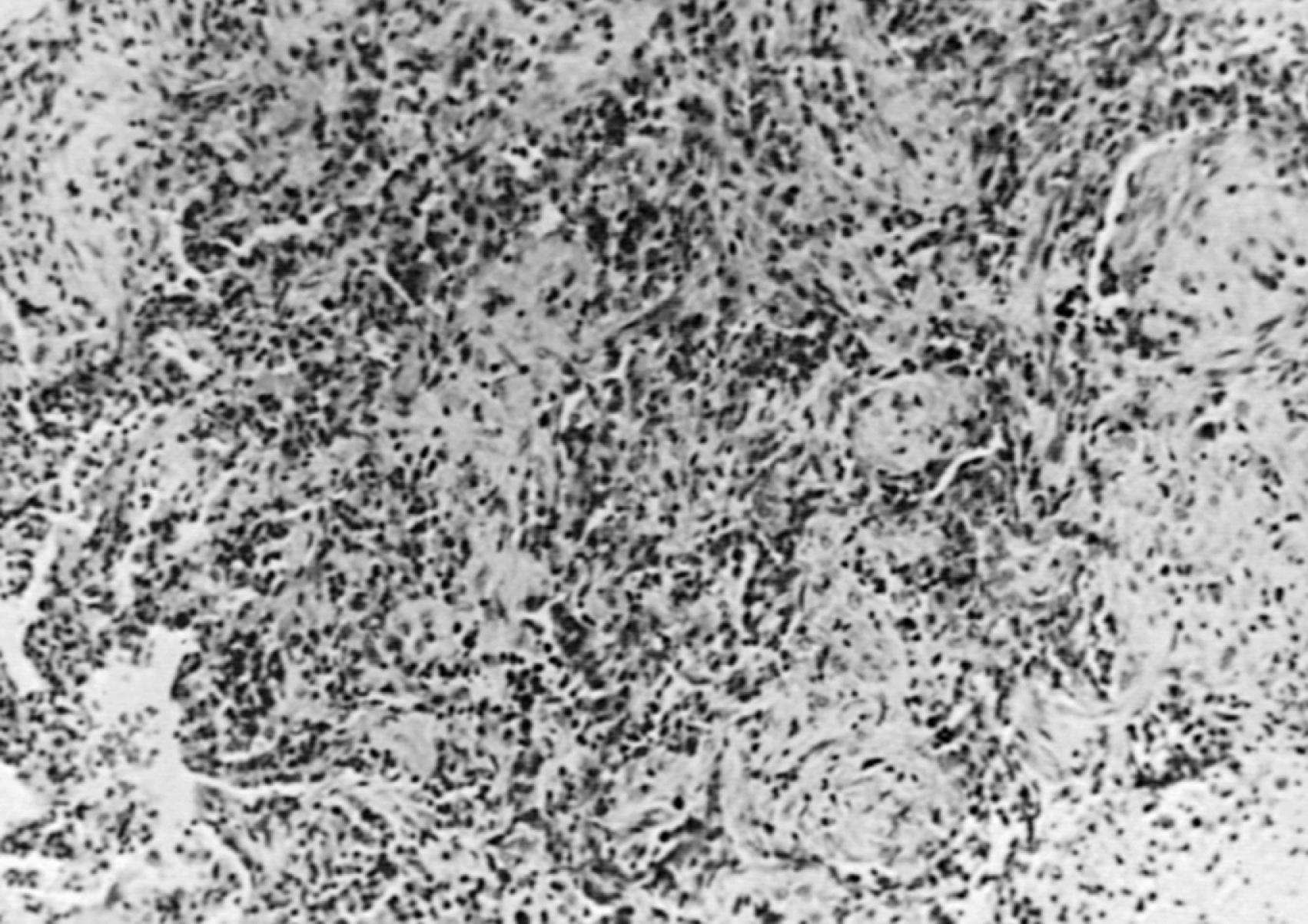 Fig. 36.3, Lung biopsy specimen from a patient with granulomatosis with polyangiitis. Necrotizing granulomata and fibrous tissue have obliterated the normal alveolar architecture. Hematoxylin-eosin stain, magnification ×480.